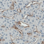Immunohistochemical staining of human liver cancer shows positivity in the sinusoids.