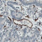 Immunohistochemical staining of human stomach cancer shows strong immunoreactivity in the blood vessels walls.