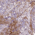 Immunohistochemical staining of human breast cancer shows moderate positivity in the extracellular matrix of tumor stroma.