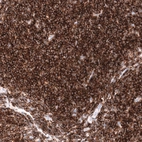 Immunohistochemical staining of human mantle cell lymphoma shows strong membranous positivity in tumor cells.
