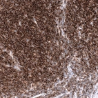 Immunohistochemical staining of human mantle cell lymphoma shows strong positivity in tumor cells.