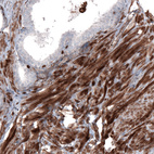 Immunohistochemical staining of human prostate shows strong cytoplasmic positivity in smooth muscle cells.