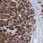 Immunohistochemical staining of human malignant melanoma shows strong cytoplasmic positivity in tumor cells.