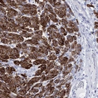 Immunohistochemical staining of human malignant melanoma shows strong cytoplasmic positivity in tumor cells.