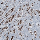 Immunohistochemical staining of human breast cancer shows nuclear positivity in tumour cells.