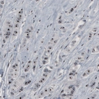 Immunohistochemical staining of human breast cancer shows strong nucleolar positivity in tumor cells.