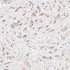 Immunohistochemical staining of human breast cancer shows weak cytoplasmic positivity in tumor cells.