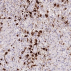 Immunohistochemical staining of human glioblastoma multiforme high grade shows strong cytoplasmic positivity in tumor cells.
