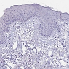 Immunohistochemical staining of human skin shows no positivity in squamous epithelial cells as expected.