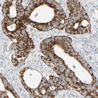 Immunohistochemical staining of human colorectal cancer shows strong granular cytoplasmic positivity in tumor cells.