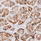 Immunohistochemical staining of human breast cancer shows moderate to strong cytoplasmic positivity in tumor cells.