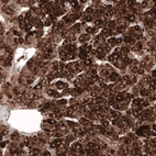 Immunohistochemical staining of human liver cancer shows strong cytoplasmic positivity in tumor cells.