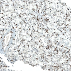 Immunohistochemical staining of human kidney cancer shows moderate to strong nuclear positivity in tumor cells.