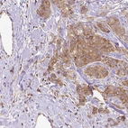 Immunohistochemical staining of human breast cancer shows moderate cytoplasmic positivity in tumor cells.
