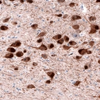 Immunohistochemical staining of human substantia nigra shows cytoplasmic positivity in dopamine neurons in pars compacta.