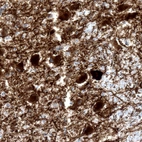 Immunohistochemical staining of human locus coeruleus shows strong cytoplasmic positivity in noradrenaline neurons.