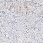Immunohistochemical staining of human breast cancer shows centrosome-like immunoreactivity in tumor cells.
