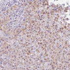 Immunohistochemical staining of human liver cancer, hepatocellular carcinoma shows moderate cytoplasmic positivity in tumor cells.