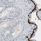 Immunohistochemical staining of human prostate cancer shows absence of nuclear immunoreactivity in tumor cells, while it is present in the adjacent normal a basal epithelial cells.