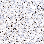 Immunohistochemical staining of human renal cancer shows strong nuclear positivity in tumor cells.