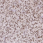 Immunohistochemical staining of human glioma shows strong nuclear positivity in tumor cells.