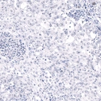 Immunohistochemical staining of human lung cancer shows no positivity in tumor cells as expected.