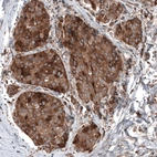 Immunohistochemical staining of human breast cancer shows strong cytoplasmic positivity in tumor cells.