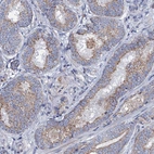 Immunohistochemical staining of human prostate cancer shows moderate membranous positivity in tumor cells.