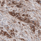 Immunohistochemical staining of human breast cancer shows membranous immunoreactivity in tumor cells.