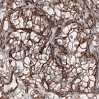 Immunohistochemical staining of human renal cancer shows membranous positivity in tumor cells.