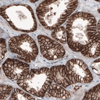 Immunohistochemical staining of human prostate cancer shows membranous positivity in tumor cells.