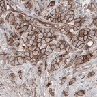 Immunohistochemical staining of human breast cancer shows membranous immunoreactivity in tumor cells.