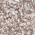 Immunohistochemical staining of human renal cancer shows membranous positivity in tumor cells.