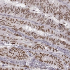 Immunohistochemical staining of human colorectal cancer shows moderate to strong nuclear positivity in tumor cells.