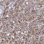 Immunohistochemical staining of human liver cancer (hepatocellular carcinoma) shows moderate to strong membranous positivity in tumor cells.