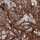Immunohistochemical staining of human breast cancer shows strong immunoreactivity in tumor stroma.
