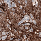 Immunohistochemical staining of human breast cancer shows strong immunoreactivity in tumor stroma.