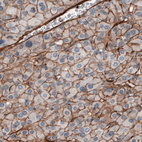 Immunohistochemical staining of human liver cancer shows strong positivity in tumor.