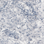 Immunohistochemical staining of human lung cancer (adenocarcinoma) shows absence of immunoreactivity (negative control).