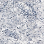 Immunohistochemical staining of human lung cancer (adenocarcinoma) shows absence of immunoreactivity (negative control).