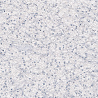 Immunohistochemical staining of human renal cancer shows absence of positivity in tumor cells as expected (negative control).